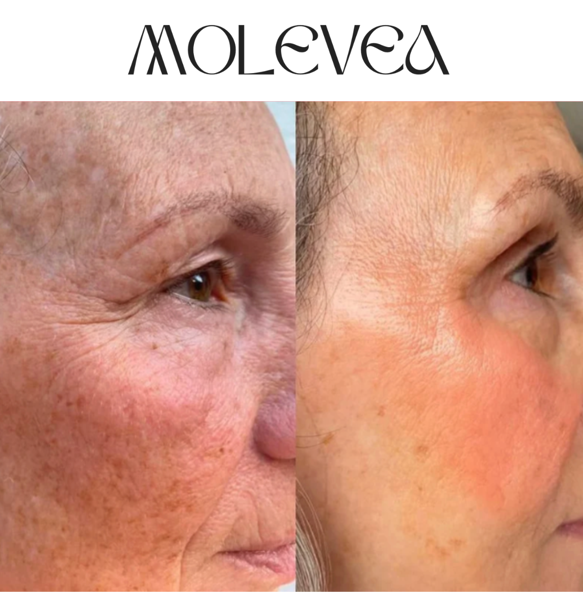 Dual Retinoid Complex 0.2 Molevea
