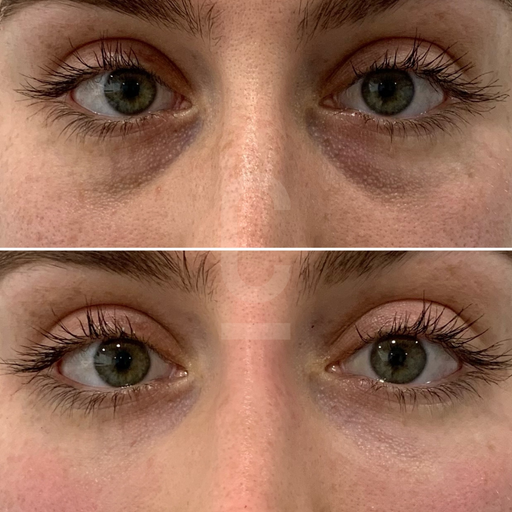 Before and after under-eye comparison, 28 days