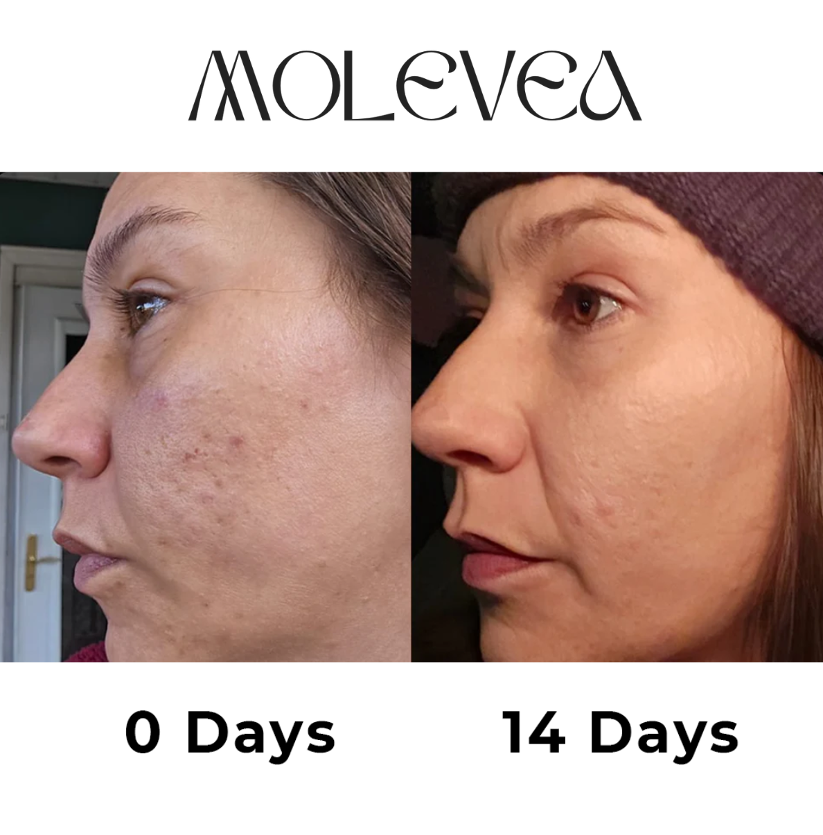 Dual Retinoid Complex 0.2 Molevea