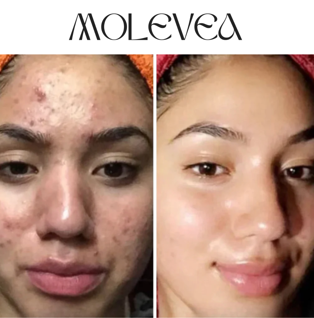 Dual Retinoid Complex 0.2 Molevea