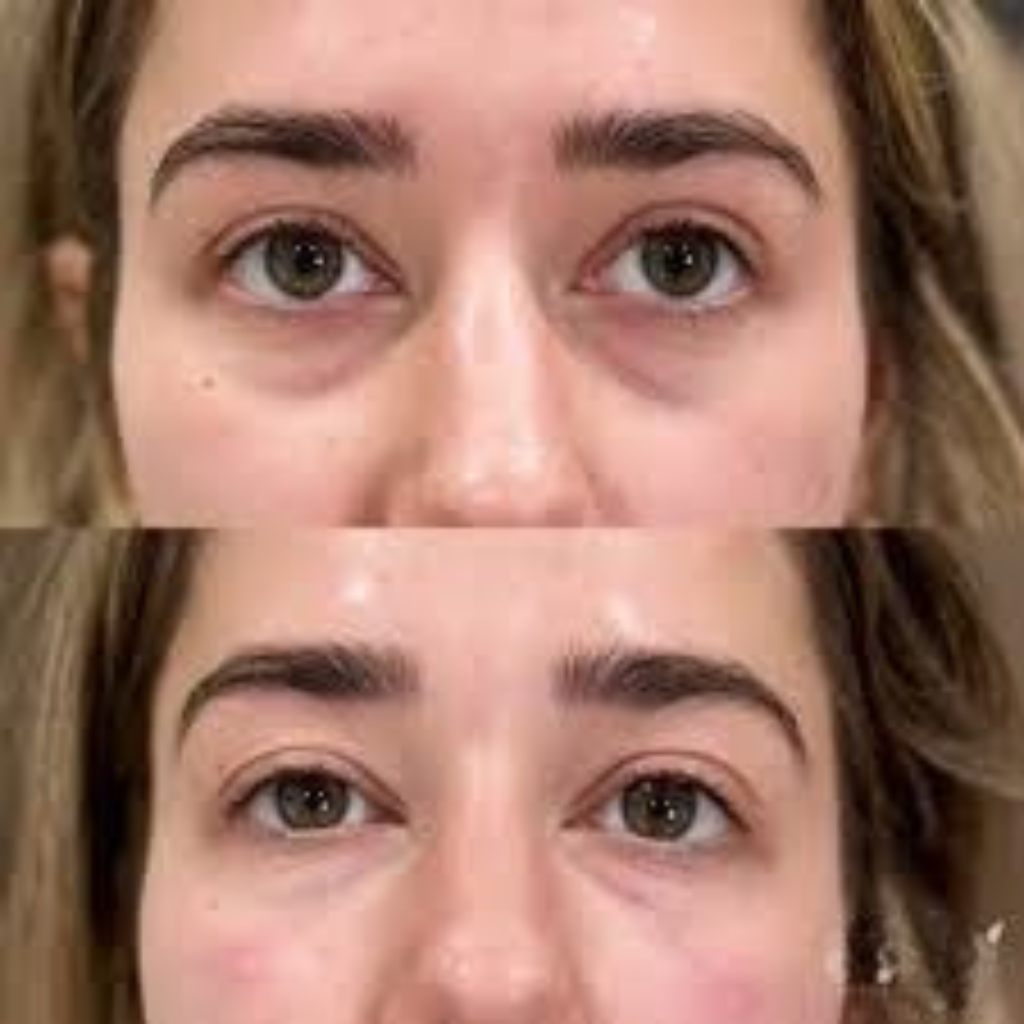 Before and after under-eye comparison, 14 days