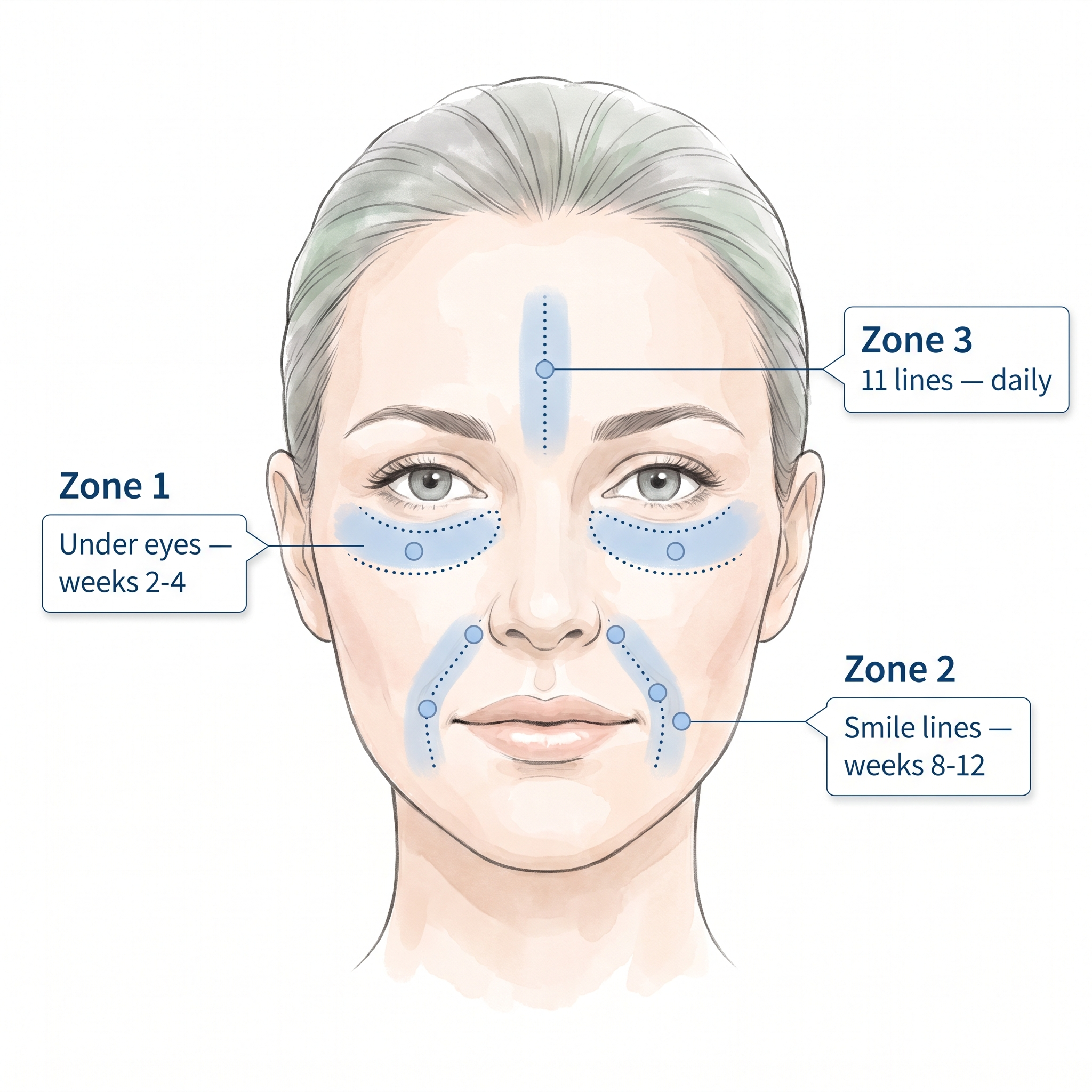 Application zones under eyes smile lines 11 lines