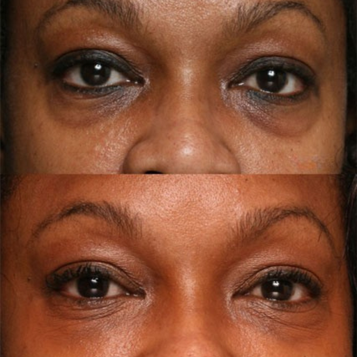 Molevea Fill Eye Cream