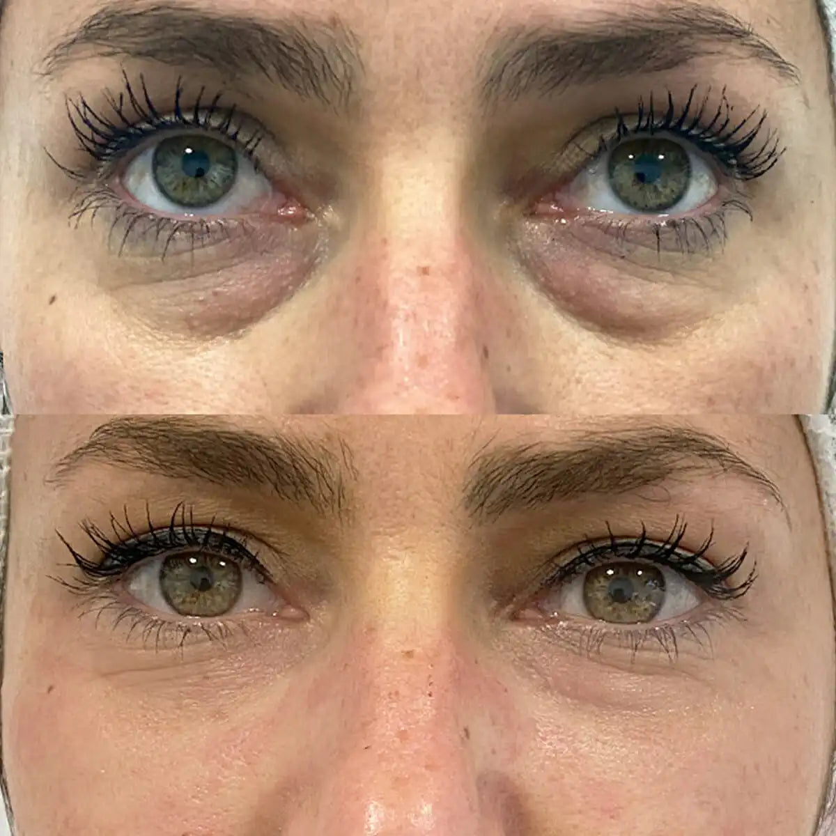 Before and after under-eye comparison, 14 days
