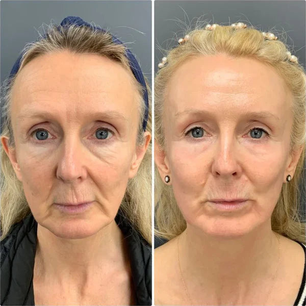Margaret T., before and after using MOLEVEA