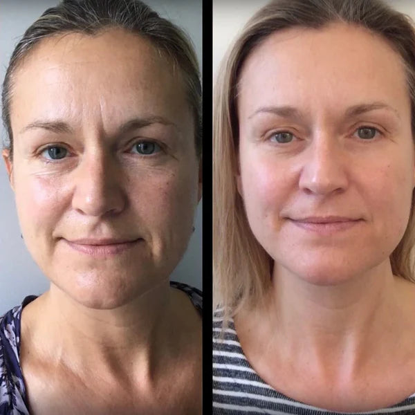 Diane K., before and after using MOLEVEA