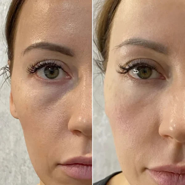 Susan L., before and after using MOLEVEA