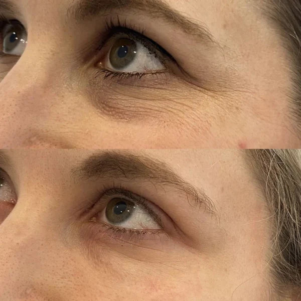 Linda R., before and after using MOLEVEA