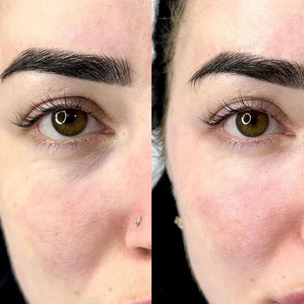 Barbara M., before and after using MOLEVEA
